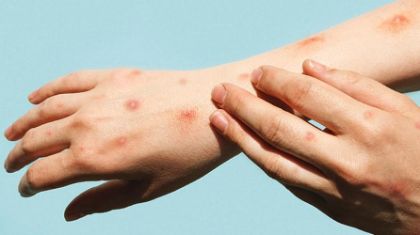 Il vaiolo delle scimmie - infezione virale causata dal monkeypox virus Il vaiolo delle scimmie - infezione virale causata dal monkeypox virus